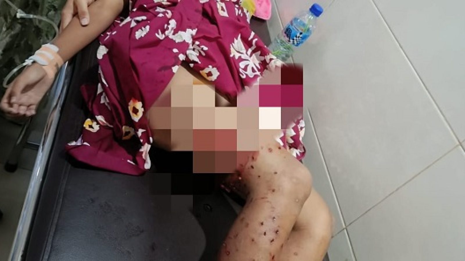 Tiga Bulan Terakhir Terjadi 82 Kasus Rabies di NTB, Terbanyak di Sumbawa