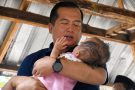 Gubernur Iqbal Atensi Penanganan Hidrosefalus